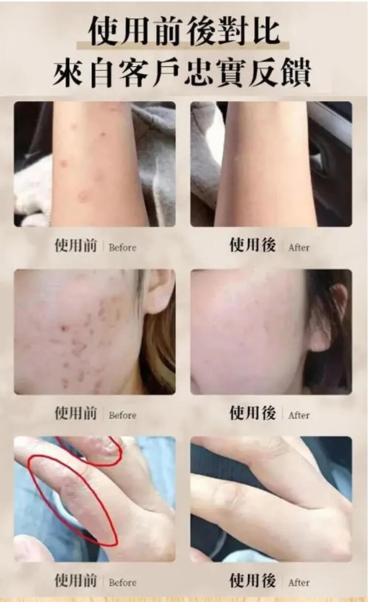 苗疆百草膏QUMAO1781067445283705.jpg 苗疆百草膏,這個藥膏絕對是買了不踩雷的,止癢超好而且不刺激很溫和,塗上舒舒服服的,到的當天我就用上了,之前晚上這腿上的蘚是癢的睡不着,現在已經徹底不癢了。也才用了一個來禮拜的樣子現在已經好了,晚上再也不會癢的睡不着了!
