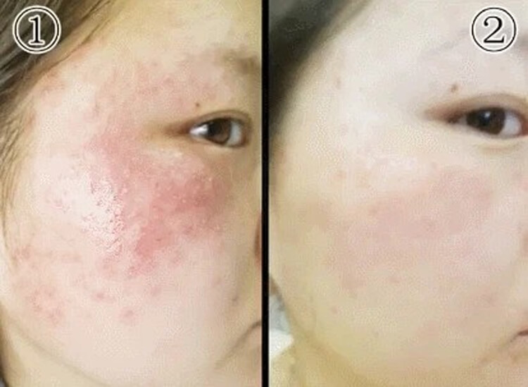 苗疆百草膏QUMAO1781067445469372.jpg 苗疆百草膏,這個藥膏絕對是買了不踩雷的,止癢超好而且不刺激很溫和,塗上舒舒服服的,到的當天我就用上了,之前晚上這腿上的蘚是癢的睡不着,現在已經徹底不癢了。也才用了一個來禮拜的樣子現在已經好了,晚上再也不會癢的睡不着了!